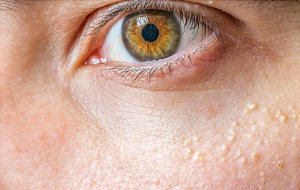 Comment traiter efficacement le grain de milium